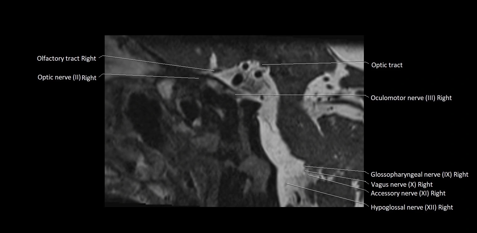 Cranial nerve sagittal anatomy MRI 3T image 40.webp